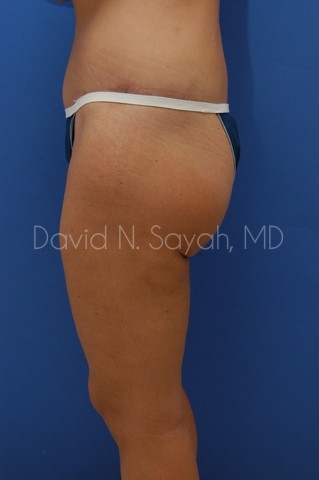 Thigh Lift Before and After | Sayah Institute