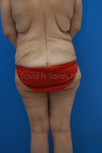 Thigh Lift Before and After | Sayah Institute