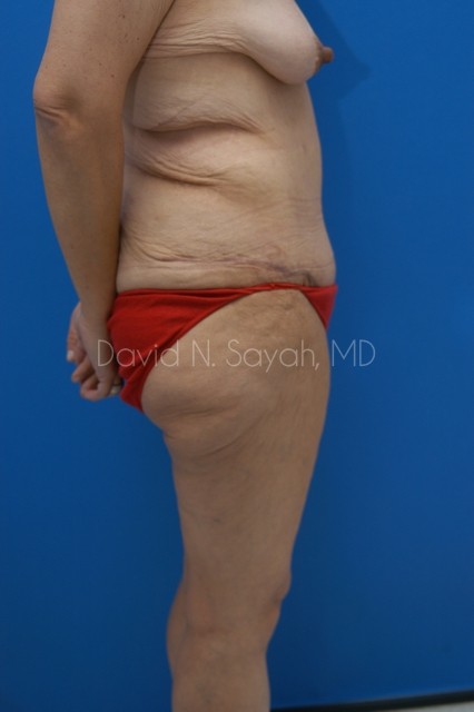 Thigh Lift Before and After | Sayah Institute