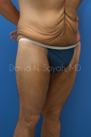 Thigh Lift Before and After | Sayah Institute