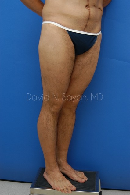 Thigh Lift Before and After | Sayah Institute