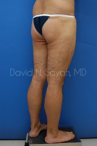 Thigh Lift Before and After | Sayah Institute