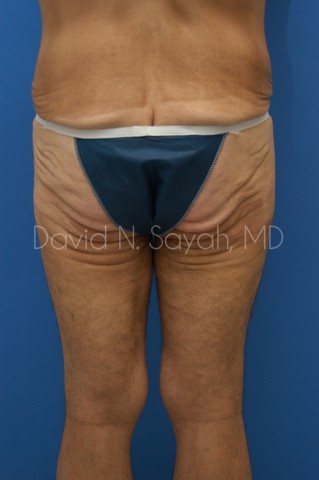 Thigh Lift Before and After | Sayah Institute