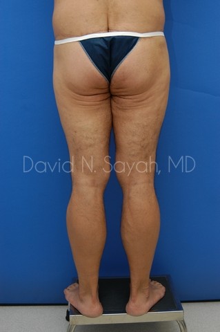 Thigh Lift Before and After | Sayah Institute