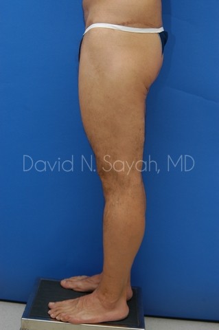 Thigh Lift Before and After | Sayah Institute