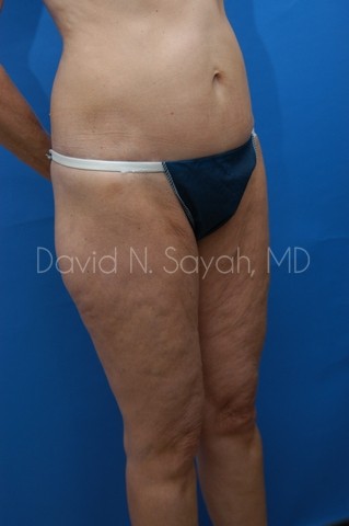 Thigh Lift Before and After | Sayah Institute
