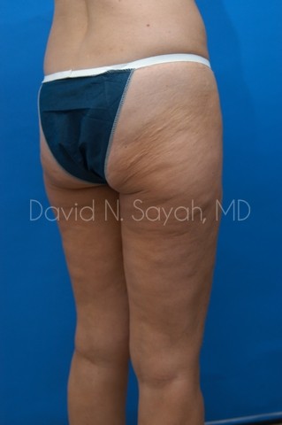 Thigh Lift Before and After | Sayah Institute
