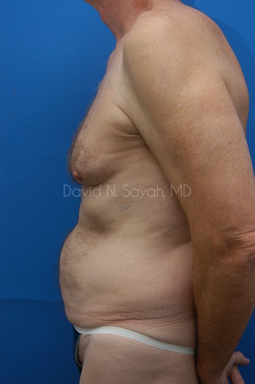 Tummy Tuck Before and After | Sayah Institute