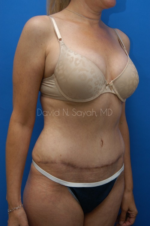 Tummy Tuck Before and After | Sayah Institute