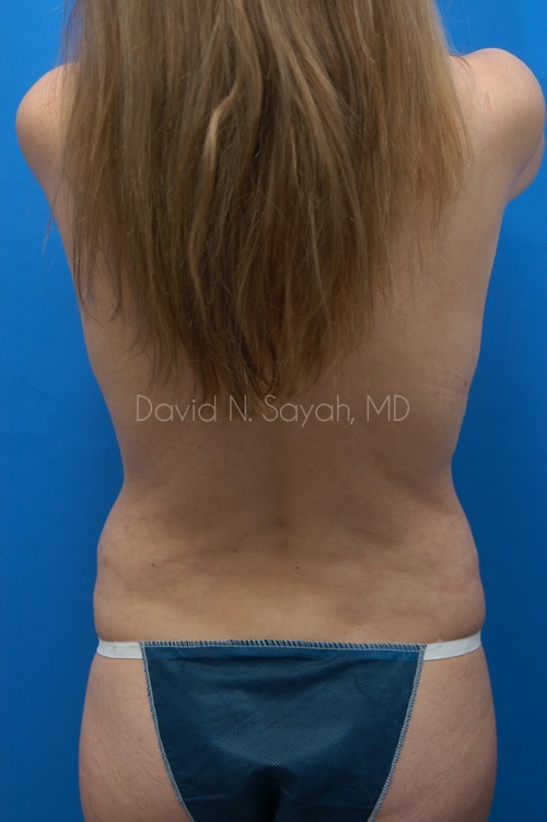 Tummy Tuck Before and After | Sayah Institute