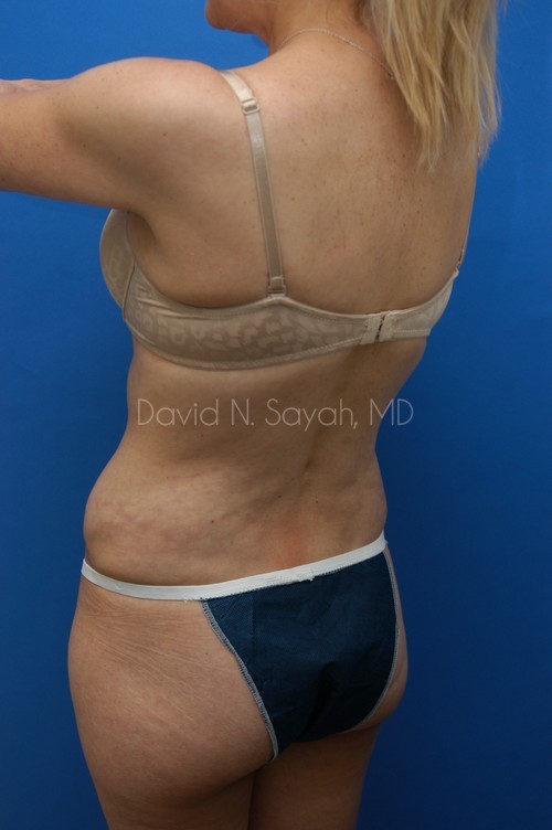Tummy Tuck Before and After | Sayah Institute