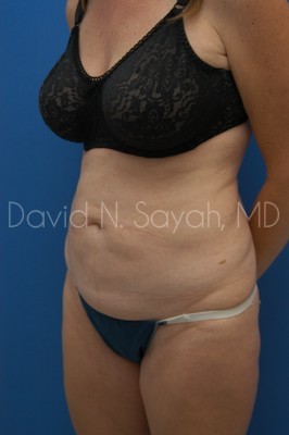 Tummy Tuck Before and After | Sayah Institute