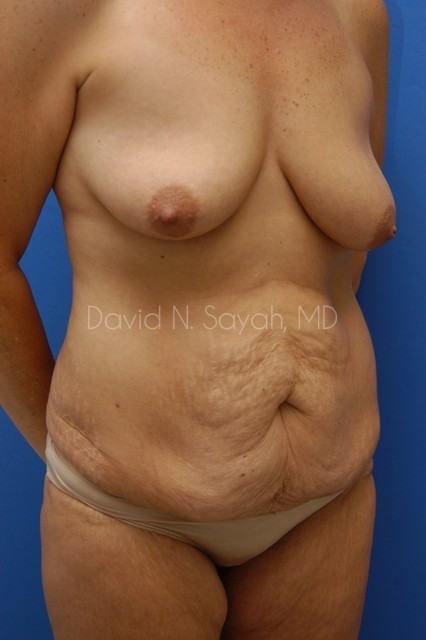 Tummy Tuck Before and After | Sayah Institute