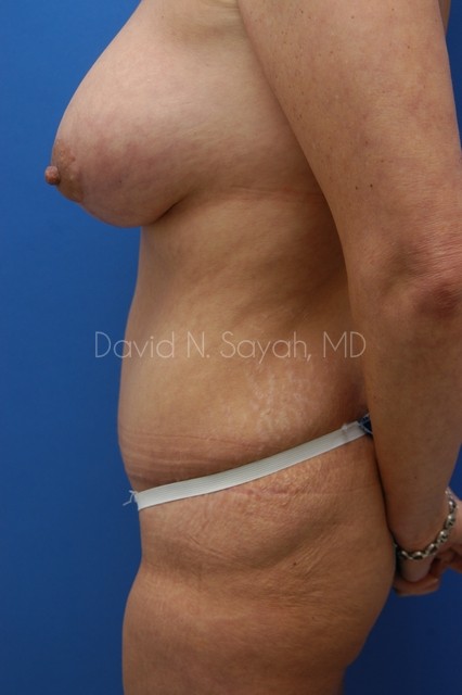 Tummy Tuck Before and After | Sayah Institute