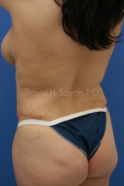 Tummy Tuck Before and After | Sayah Institute