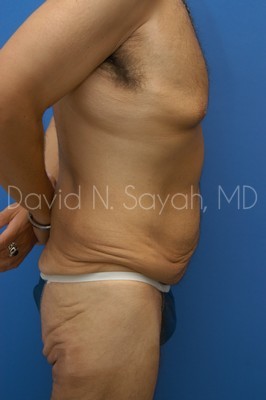 Tummy Tuck Before and After | Sayah Institute