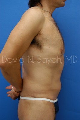 Tummy Tuck Before and After | Sayah Institute