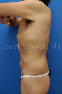 Tummy Tuck Before and After | Sayah Institute