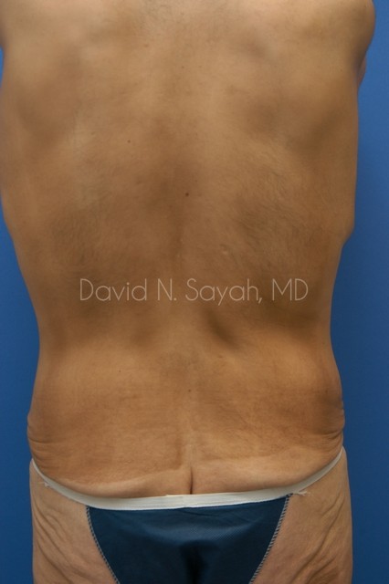Tummy Tuck Before and After | Sayah Institute