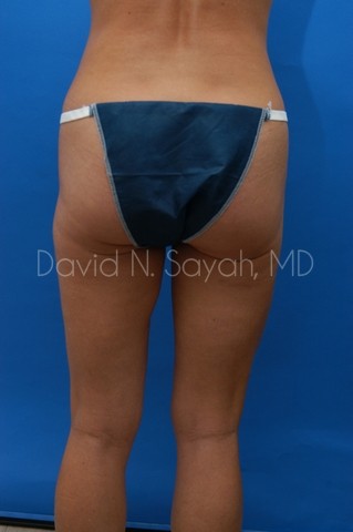 Tummy Tuck Before and After | Sayah Institute