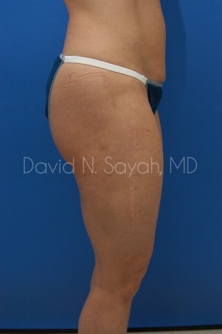 Tummy Tuck Before and After | Sayah Institute