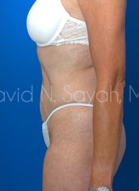 Tummy Tuck Before and After | Sayah Institute